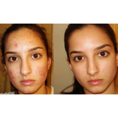Luron Pimple Cream